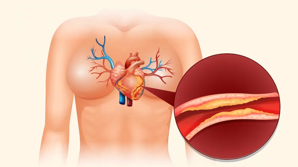 Angioplasty Adalah Solusi Modern untuk Jantungan, Apa Itu?