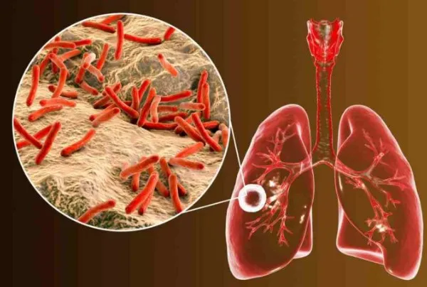 Apa yang Terjadi Jika Pasien Kanker Terinfeksi Bakteri Tuberculosis?
