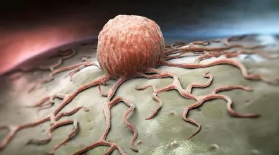 Apakah Semua Tumor Itu Kanker?