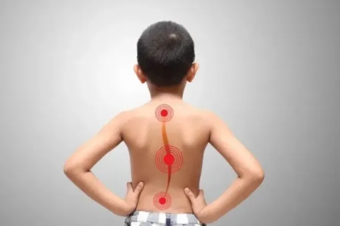 Apakah Skoliosis Bisa Sembuh? Opsi Pengobatan Modern dan Fisioterapi di Malaysia