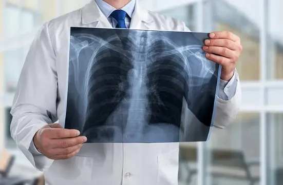 Cara Membaca Hasil Rontgen Paru Paru untuk Deteksi Dini TBC