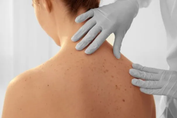 Dermatofibrosarkoma Protuberans Kanker Kulit Langka yang Perlu Kamu Tahu