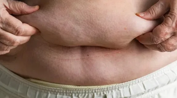 Hubungan Obesitas dan Risiko Kanker