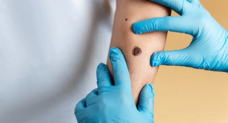 Inovasi Medis dalam Pengobatan Kanker Kulit Melanoma