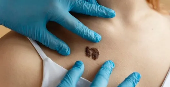 Melanoma, Jenis Kanker Kulit yang Berbahaya dan Cara Mengobatinya