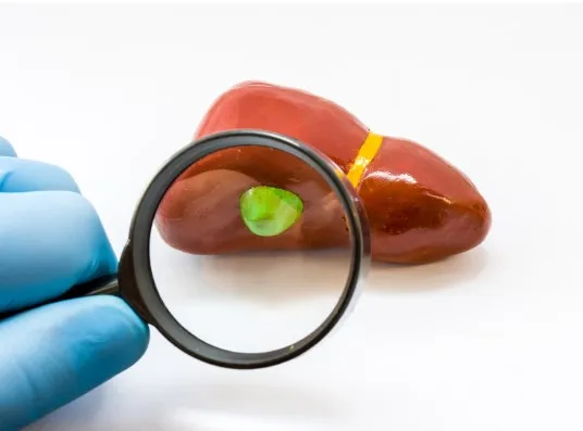 Mengenal Kanker Cholangiocarcinoma Gejala, Penyebab, dan Pengobatan