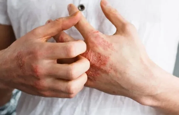 Neurosarcoidosis Ketika Penyakit Autoimun Menyerang Saraf