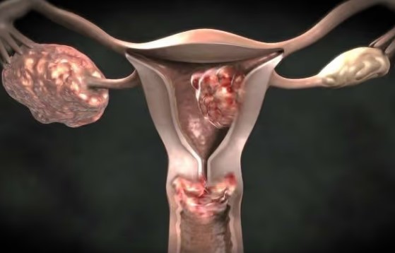 Pengobatan Kanker Vagina di Modern Cancer Hospital Guangzhou
