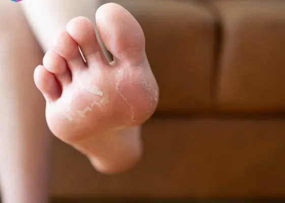 Penyakit yang Rentan Muncul Akibat Diabetes