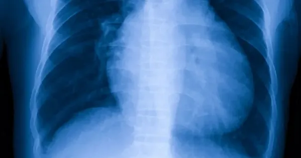 Penyebab, Risiko, dan Cara Menghadapi Cardiomegaly