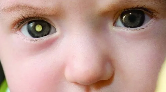 Retinoblastoma Kanker Mata yang Umumnya Menyerang Anak Anak