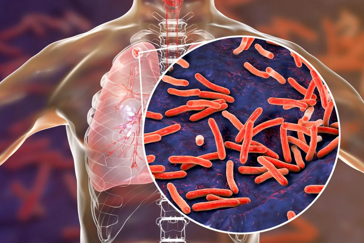 Spesialis Tuberkulosis: Peran Krusial dalam Melawan Penyakit yang Masih Mengintai