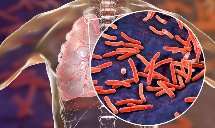 Tanda-Tanda Awal Tuberkulosis (TBC) yang Tidak Boleh Diabaikan