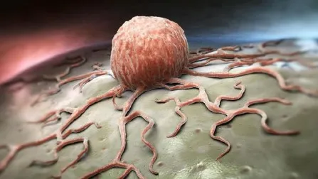 Tumor Ganas Bisa Disembuhkan? Ini Pilihan Pengobatannya