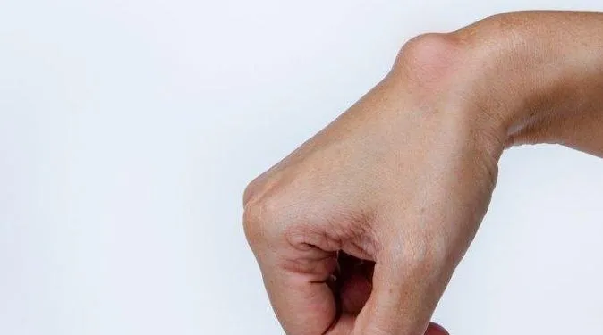 Wajib Dicoba! 5 Cara Alami Mengobati Tumor Tanpa Operasi